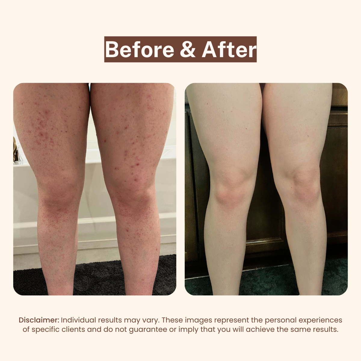 BBL Serum - 3-in-1 Bikini Line Serum